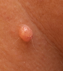 Small lump or skin tag